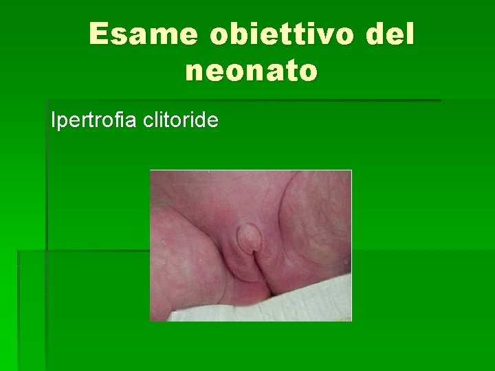 Esame obiettivo del neonato Ipertrofia clitoride 