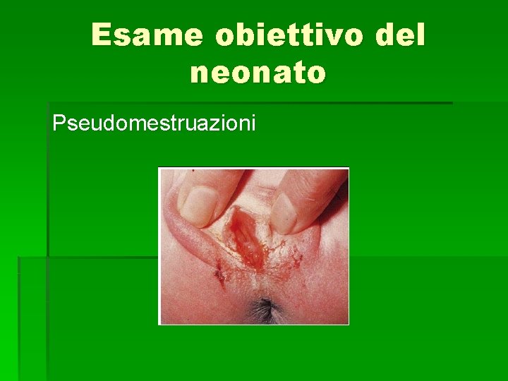 Esame obiettivo del neonato Pseudomestruazioni 