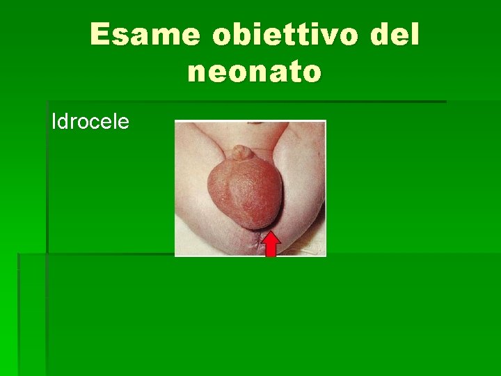 Esame obiettivo del neonato Idrocele 