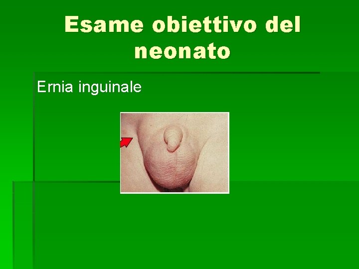 Esame obiettivo del neonato Ernia inguinale 