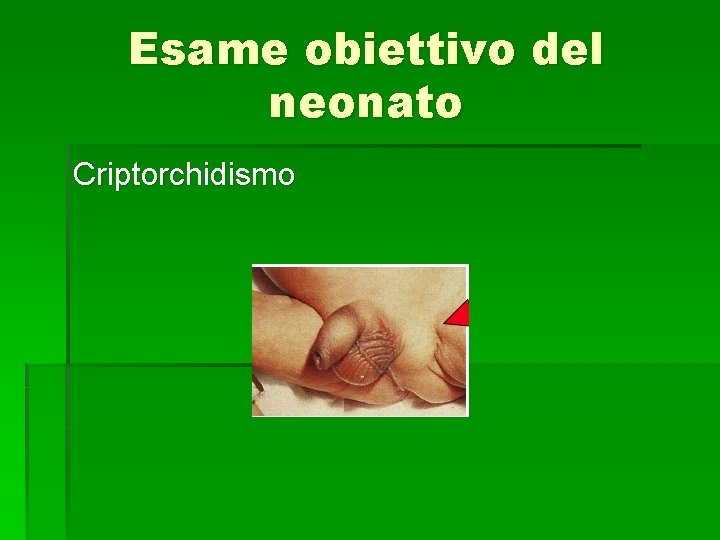 Esame obiettivo del neonato Criptorchidismo 