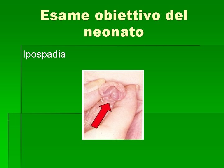 Esame obiettivo del neonato Ipospadia 