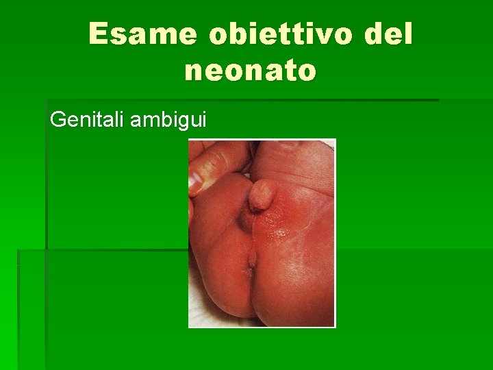 Esame obiettivo del neonato Genitali ambigui 