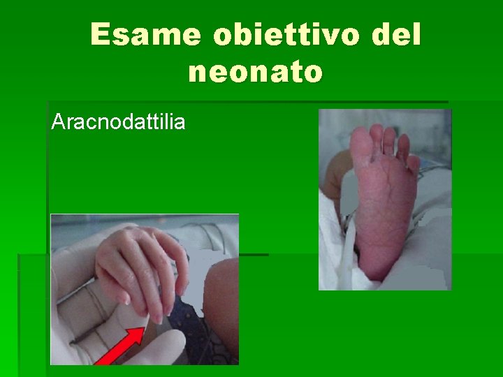 Esame obiettivo del neonato Aracnodattilia 