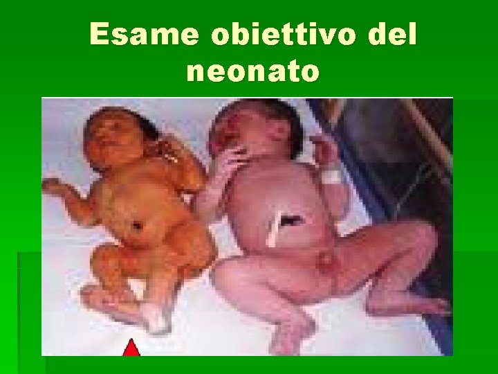 Esame obiettivo del neonato 