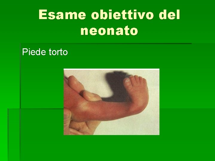 Esame obiettivo del neonato Piede torto 