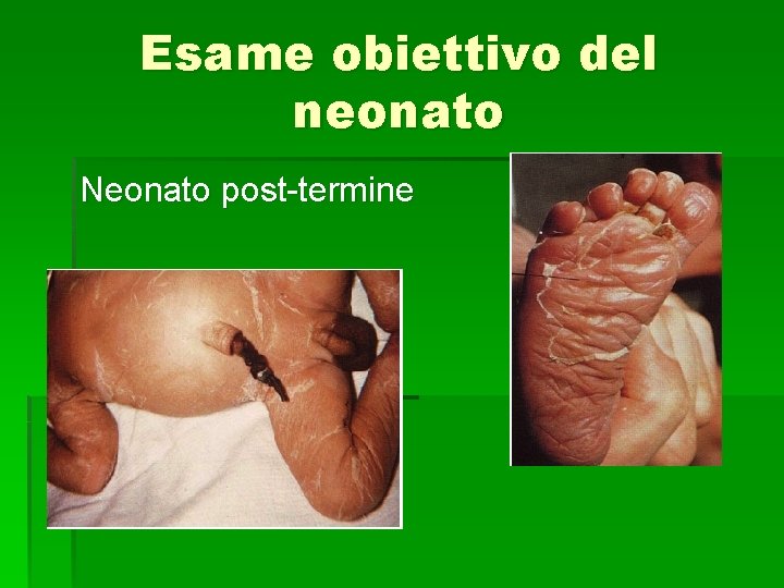 Esame obiettivo del neonato Neonato post-termine 