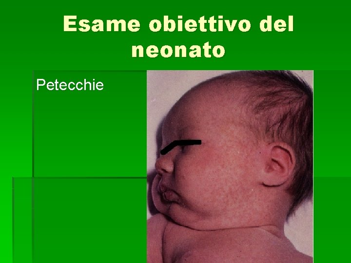 Esame obiettivo del neonato Petecchie 