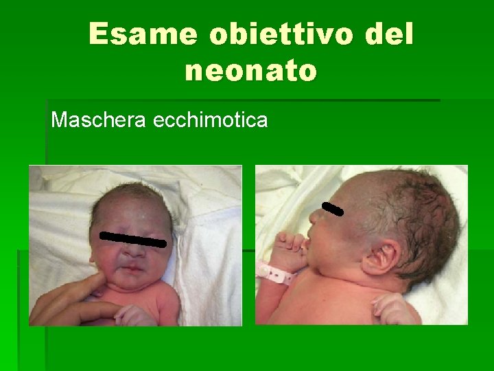 Esame obiettivo del neonato Maschera ecchimotica 