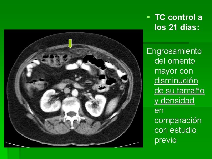 § TC control a los 21 días: Engrosamiento del omento mayor con disminución de