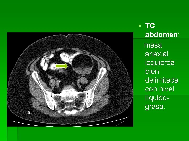 § TC abdomen: masa anexial izquierda bien delimitada con nivel líquidograsa. 