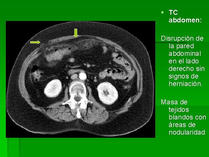 § TC abdomen: Disrupción de la pared abdominal en el lado derecho sin signos