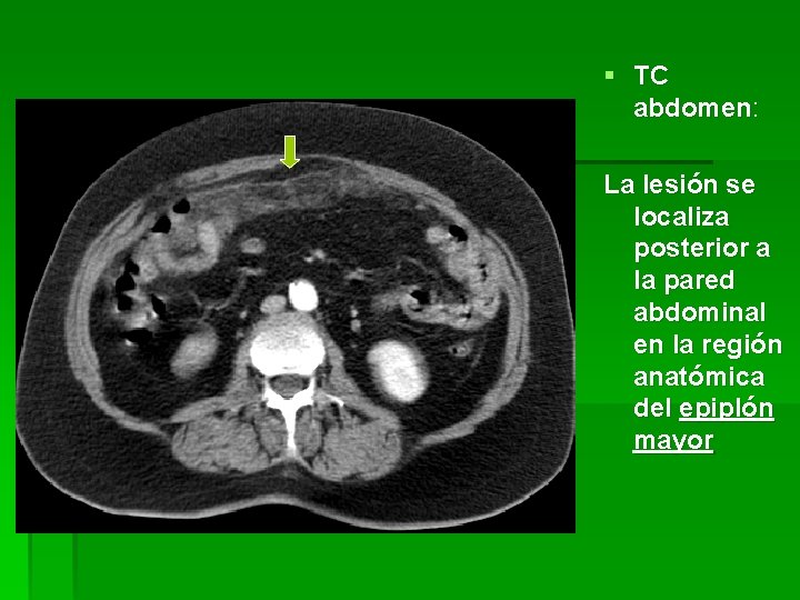 § TC abdomen: La lesión se localiza posterior a la pared abdominal en la