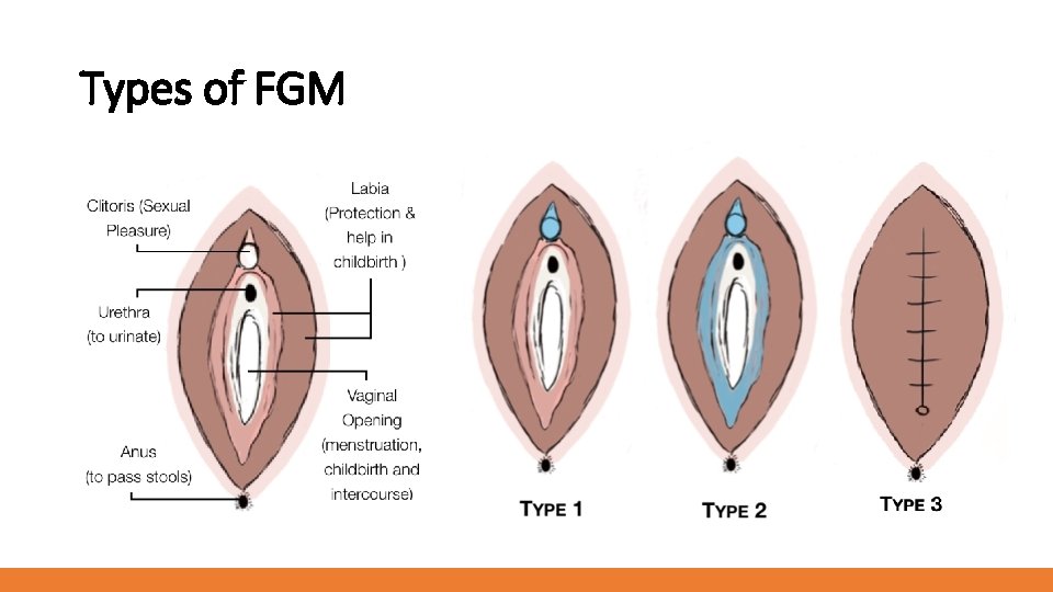 Types of FGM 