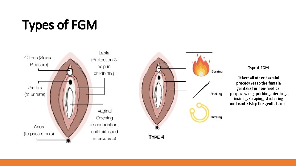 Types of FGM Type 4 FGM Other: all other harmful procedures to the female