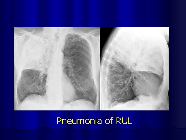 Pneumonia of RUL 