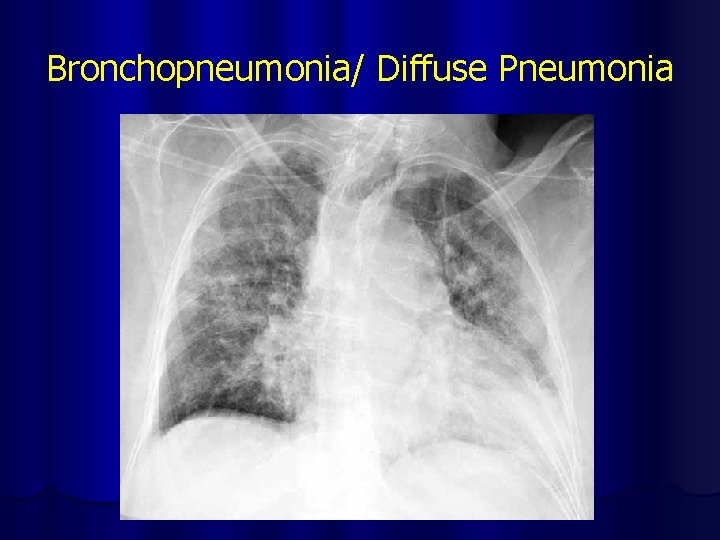 Bronchopneumonia/ Diffuse Pneumonia 