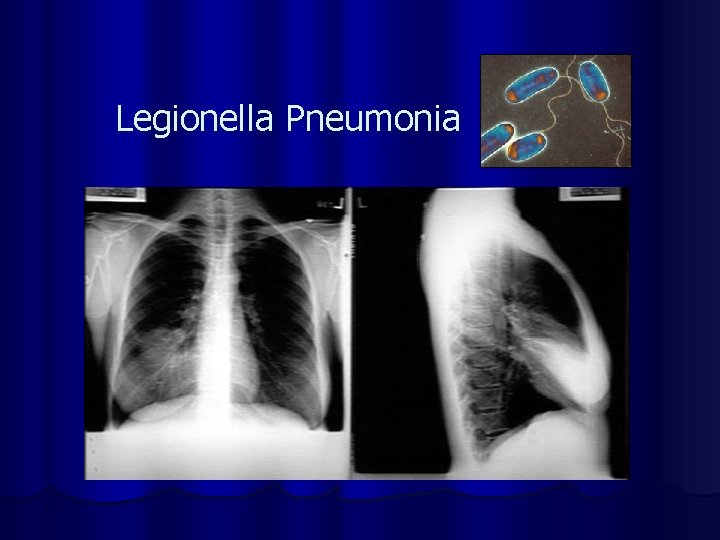 Legionella Pneumonia 