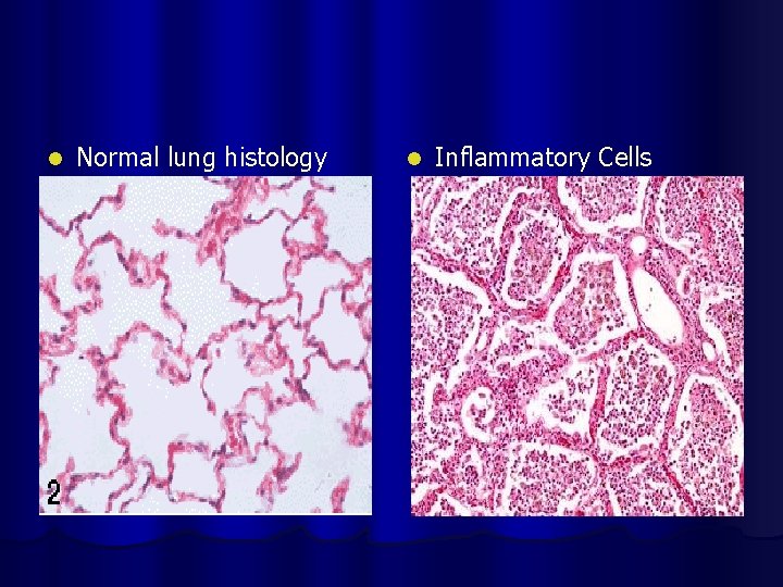 l Normal lung histology l Inflammatory Cells ls. Pneumonia 