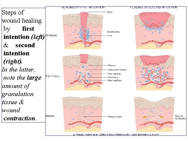 Steps of wound healing by first intention (left) & second intention (right). In the
