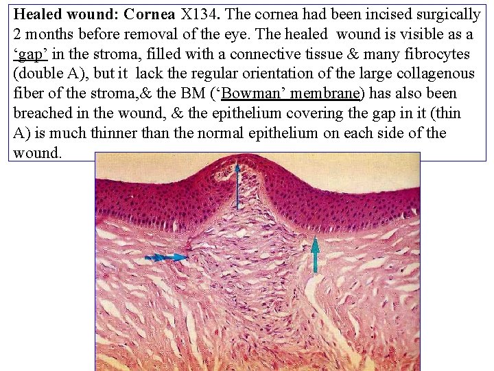 Healed wound: Cornea X 134. The cornea had been incised surgically 2 months before