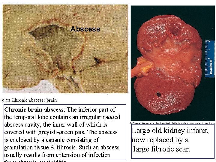 Abscess Chronic brain abscess. The inferior part of the temporal lobe contains an irregular