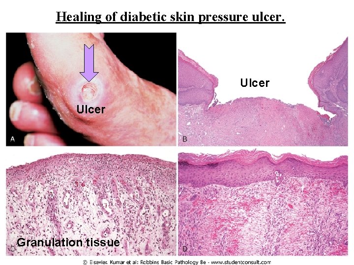 Healing of diabetic skin pressure ulcer. Ulcer Granulation tissue 
