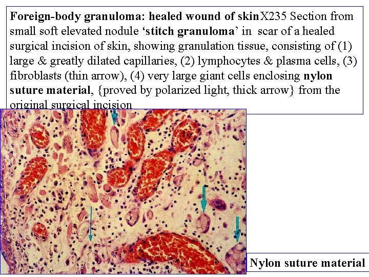 Foreign-body granuloma: healed wound of skin. X 235 Section from small soft elevated nodule