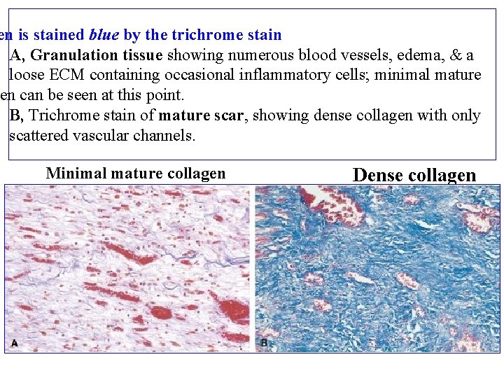en is stained blue by the trichrome stain A, Granulation tissue showing numerous blood