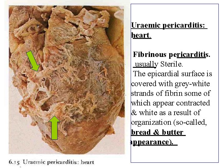 Uraemic pericarditis: heart. Fibrinous pericarditis. usually Sterile. The epicardial surface is covered with grey-white