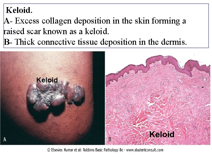 Keloid. A- Excess collagen deposition in the skin forming a raised scar known as