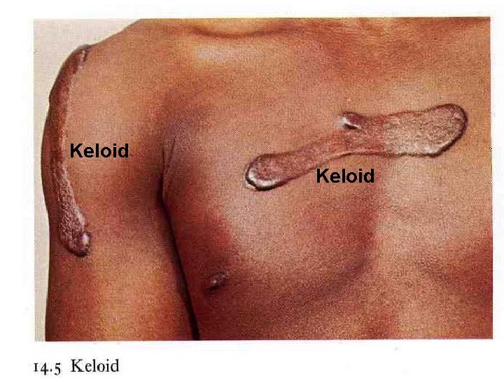 Keloid 