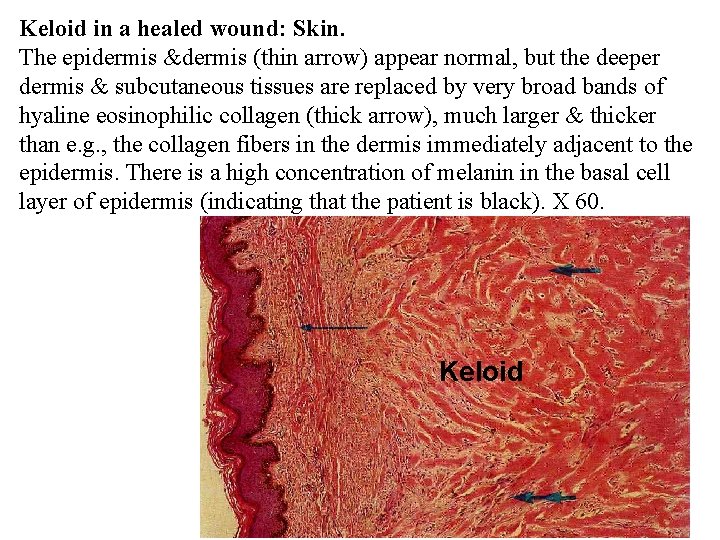 Keloid in a healed wound: Skin. The epidermis &dermis (thin arrow) appear normal, but