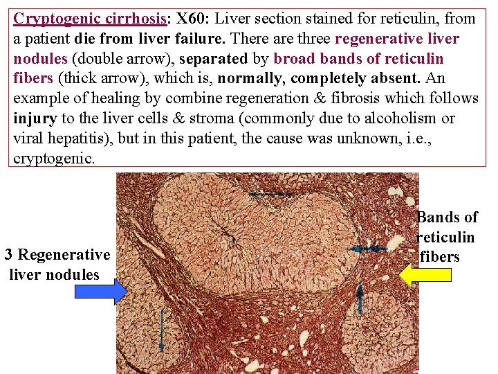 Cryptogenic cirrhosis: X 60: Liver section stained for reticulin, from a patient die from