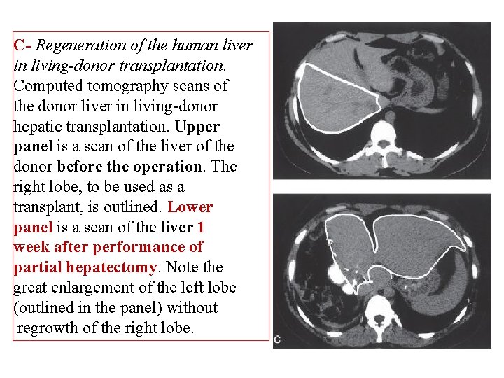 C- Regeneration of the human liver in living-donor transplantation. Computed tomography scans of the