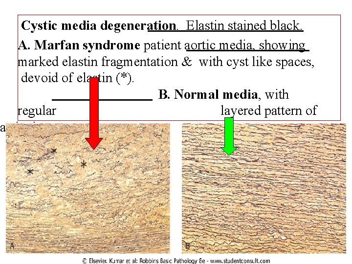 Cystic media degeneration. Elastin stained black. A. Marfan syndrome patient aortic media, showing marked