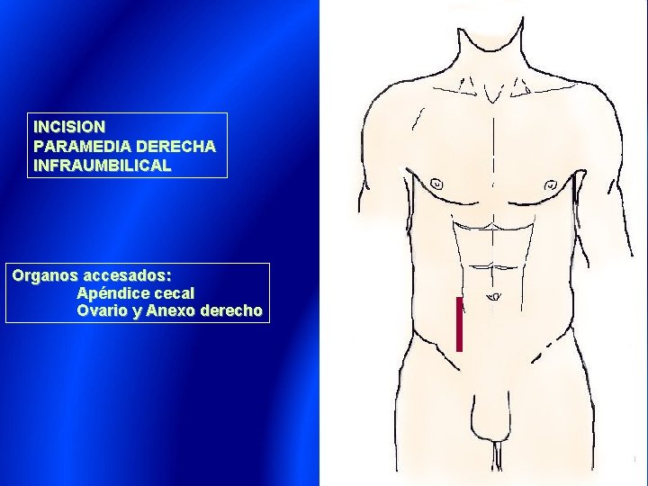 INCISION PARAMEDIA DERECHA INFRAUMBILICAL Organos accesados: Apéndice cecal Ovario y Anexo derecho 