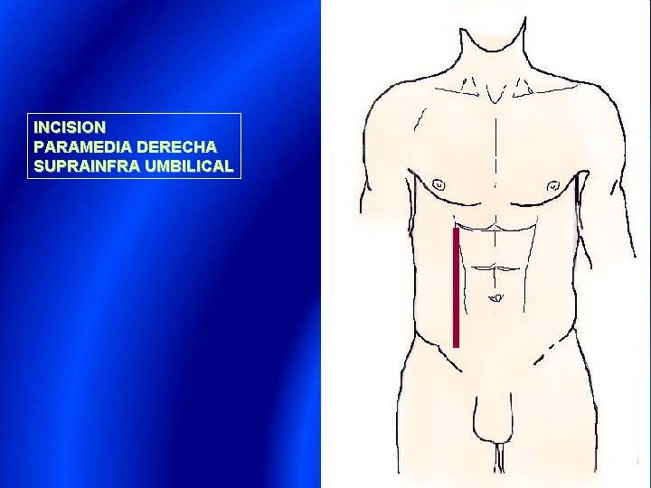 INCISION PARAMEDIA DERECHA SUPRAINFRA UMBILICAL 