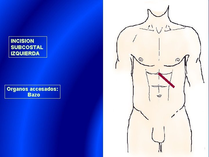 INCISION SUBCOSTAL IZQUIERDA Organos accesados: Bazo 