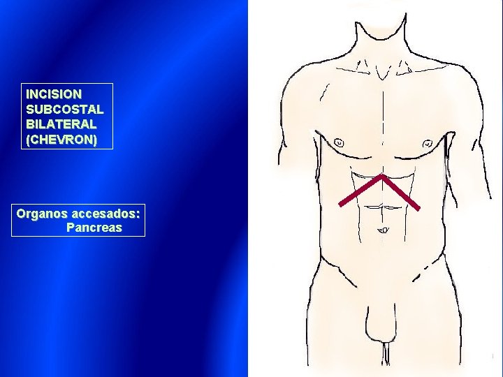 INCISION SUBCOSTAL BILATERAL (CHEVRON) Organos accesados: Pancreas 