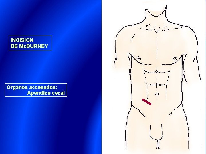 INCISION DE Mc. BURNEY Organos accesados: Apendice cecal 