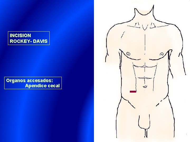 INCISION ROCKEY- DAVIS Organos accesados: Apendice cecal 