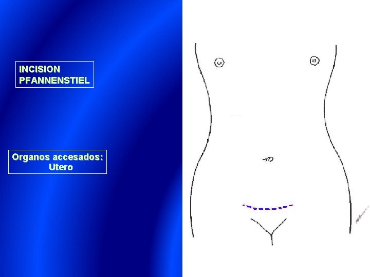 INCISION PFANNENSTIEL Organos accesados: Utero 