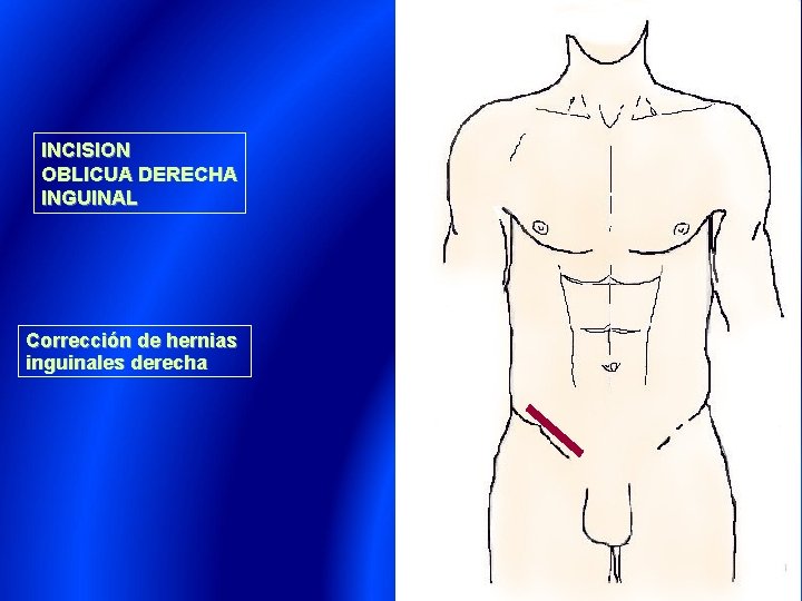 INCISION OBLICUA DERECHA INGUINAL Corrección de hernias inguinales derecha 