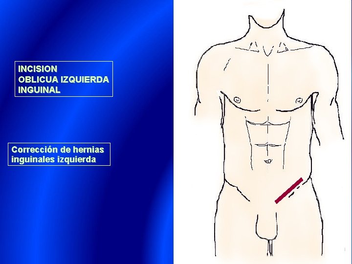 INCISION OBLICUA IZQUIERDA INGUINAL Corrección de hernias inguinales izquierda 