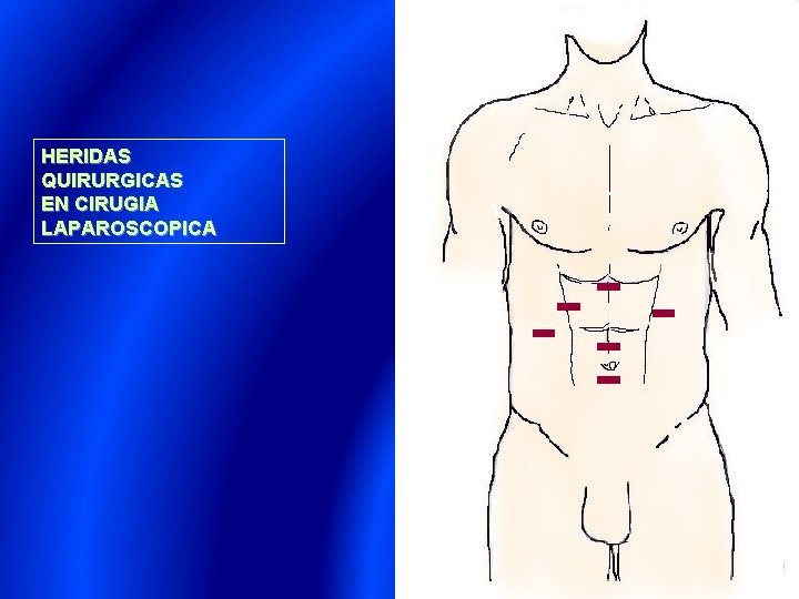 HERIDAS QUIRURGICAS EN CIRUGIA LAPAROSCOPICA 