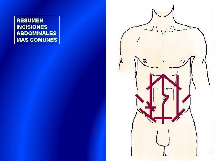 RESUMEN INCISIONES ABDOMINALES MAS COMUNES 