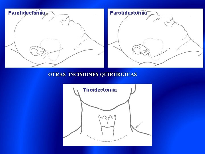 Parotidectomia OTRAS INCISIONES QUIRURGICAS Tiroidectomia 