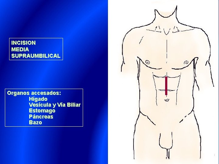 INCISION MEDIA SUPRAUMBILICAL Organos accesados: Hígado Vesícula y Vía Biliar Estomago Páncreas Bazo 