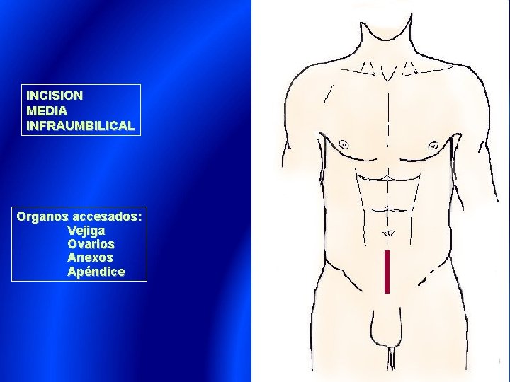 INCISION MEDIA INFRAUMBILICAL Organos accesados: Vejiga Ovarios Anexos Apéndice 